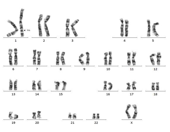 Кариограмма это. Дупликация хромосом кариотип. Трисомия 22 хромосомы кариотип. Дифференциальной окрасках кариотип человека. Кариограмма женщины.