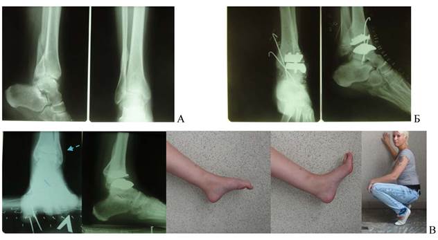 Голеностопа после операции. Перелом голеностопного сустава пластины. Ложный сустав голеностопа.