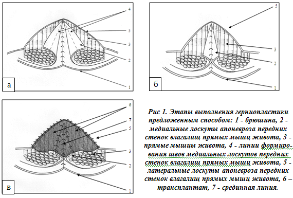 Схема индийского клина. Строение герниопластика схема. Методика открытой интраперитонеальной аллогерниопластики. Герниопластика по Шулдайсу кратко.