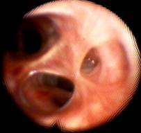 Stenosis S4b