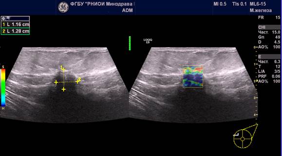 Мастопатия молочной железы узи