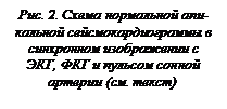Подпись: Рис. 2. Схема нормальной апи-каль¬ной сейсмокардиограммы в син¬хронном изображении с ЭКГ, ФКГ и пульсом сонной артерии (см. текст)