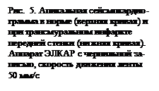 Подпись: Рис.  5. Апикальная сейсмокардио-грамма в норме (верхняя кривая) и при трансмуральном инфаркте передней стенки (нижняя кривая). Аппарат ЭЛКАР с чернильной за-писью, скорость движения ленты 50 мм/с