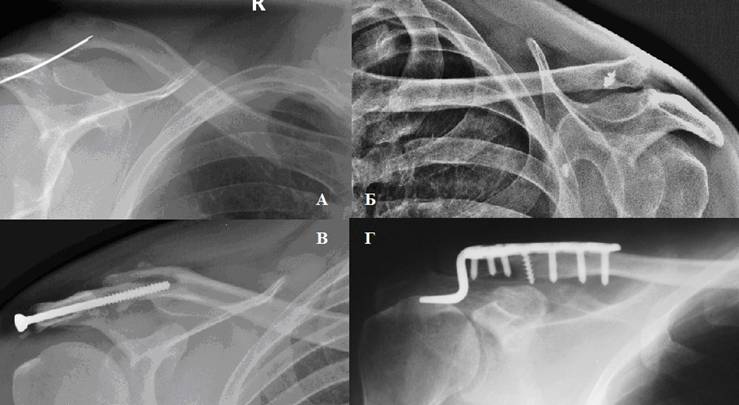 Разрыв ключицы фото