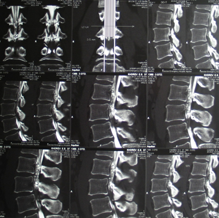 Поясничного отдела позвоночника + миелография. Спондилез l5-s1. Дегенеративные-дистрофических изменений l1-s1. Мрт пояснично крестцового отдела позвоночника миелография.