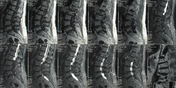 Mp картина дегенеративно дистрофических изменений пояснично крестцового отдела позвоночника