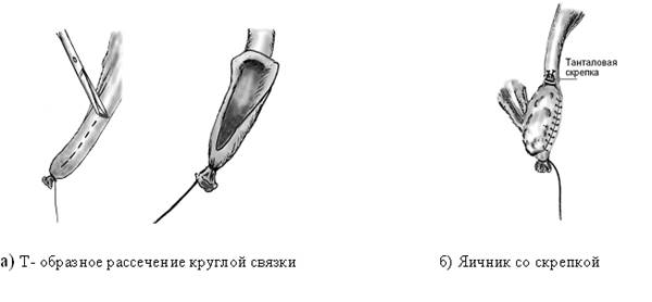 Описание: C:\Users\Гинекология 2\Desktop\КРУЗЕ\статьи 2009\рец журнал\Рисунки\Рисунок 1.tif