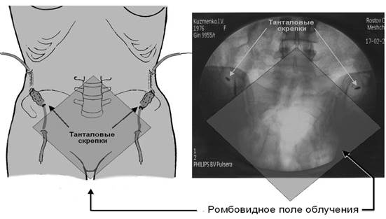 Описание: C:\Users\Гинекология 2\Desktop\КРУЗЕ\статьи 2009\рец журнал\Рисунки\Рисунок 3.tif