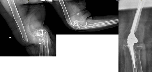Контрактура после эндопротезирования. Эндопротез локтевого сустава Зиммер. Контрактура локтевого сустава на рентгене. Экхондрома локтевого сустава. Эндопротез локтевого сустава Zimmer.