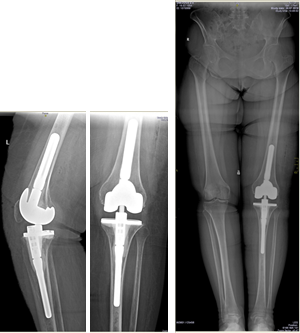 Почему колено после эндопротезирования. Эндопротез бедренной кости коленного сустава. Остеомиелит бедренной кости после эндопротезирования. Остеомиелит эндопротеза коленного сустава. Эндопротез коленного сустава рентген.
