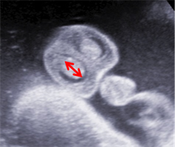 Яички мальчика видео. УЗИ половые органы мальчика 32 неделя. Опустившиеся яички плода на УЗИ.