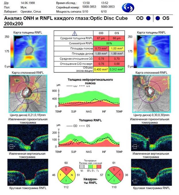 Оптическая когерентная томография диска зрительного нерва
