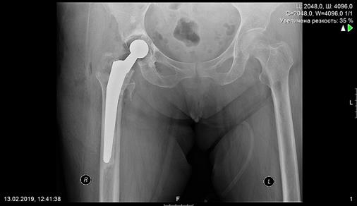 Последствия перелома бедра мкб 10