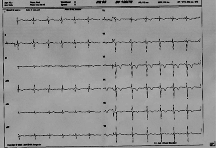 Ишемия передней стенки на экг у ребенка