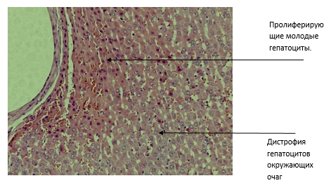 Хронический вирусный гепатит c. Пролиферация печени. Гидропическая дистрофия печени гистология. Купферовских клеток. Пролиферация это гистология.