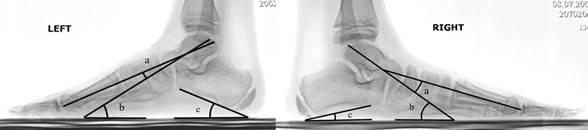 У ребенка укорочение ахиллова сухожилия. Гипсовая иммобилизация, ахиллова сухожилия. Пластика ахиллово сухожилие. Разрыв ахиллова сухожилия на узи. Тендинопатия ахиллова сухожилия.