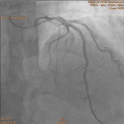 пмжв после птка