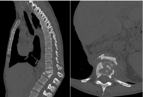Изображение выглядит как Медицинская визуализация, радиология, рентгеновская пленка, рентгенография

Содержимое, созданное искусственным интеллектом, может быть неверным.