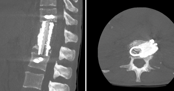Изображение выглядит как рентгеновская пленка, Медицинская визуализация, радиология, рентгенография

Содержимое, созданное искусственным интеллектом, может быть неверным.