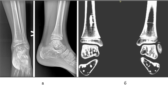 Изображение выглядит как рентгеновская пленка, Медицинская визуализация, Рентгеновское излучение, Медицинская рентгенография
Содержимое, созданное искусственным интеллектом, может быть неверным.