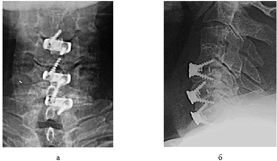 Изображение выглядит как рентгеновская пленка, снимок экрана, черно-белый, Черно-белая фотография

Содержимое, созданное искусственным интеллектом, может быть неверным.